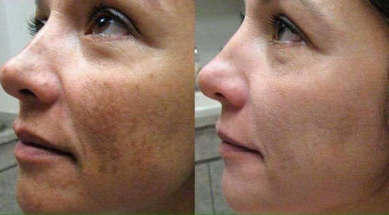 180°® AHA Facial Peel and Neutralizer