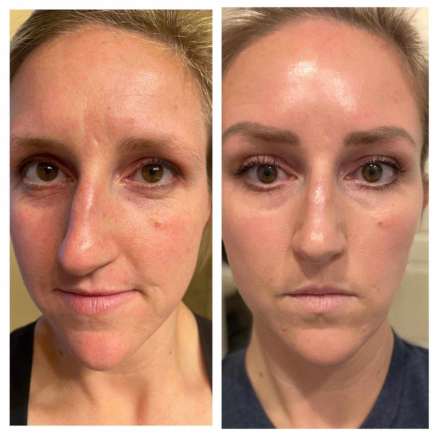 LumiSpa iO Rose Gold with Cleanser