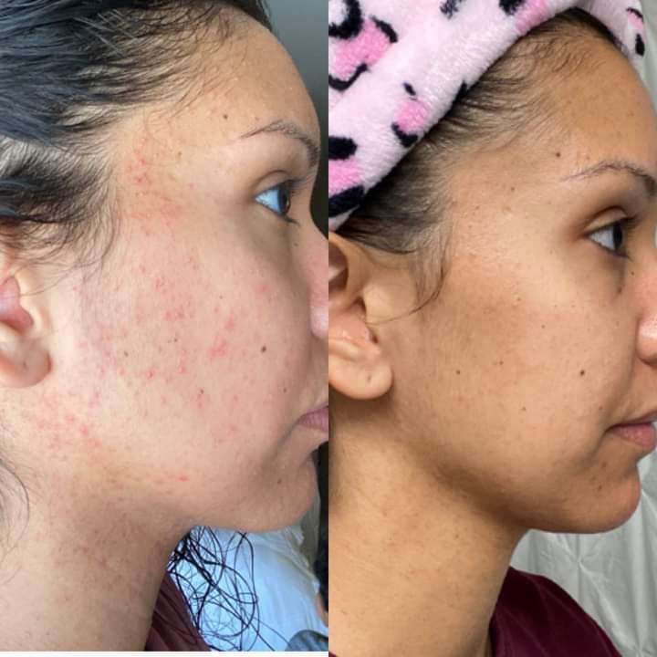 LumiSpa iO Rose Gold with Cleanser